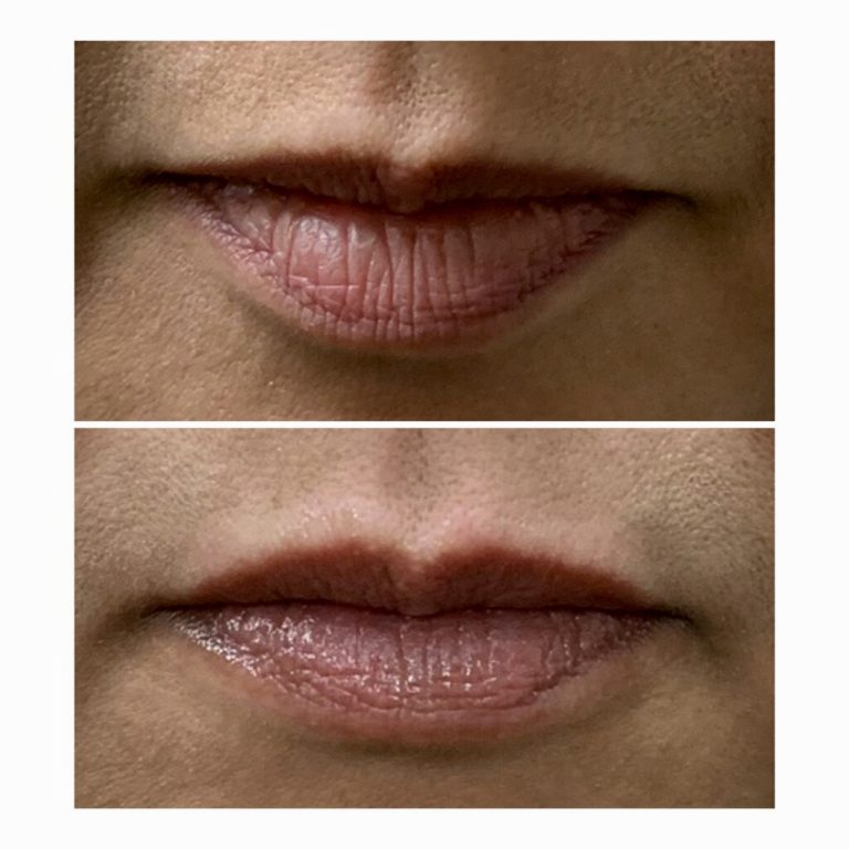 Liplase Gentle laser lip rejuvenation Boynton Laser Dental Center